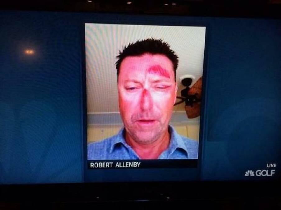 A photo showing Robert Allenby's injuries was aired on television. Photo: Twitter
