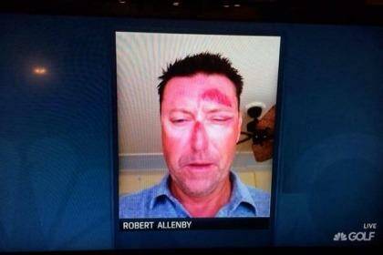 A photo showing Robert Allenby's injuries was aired on television. Photo: Twitter